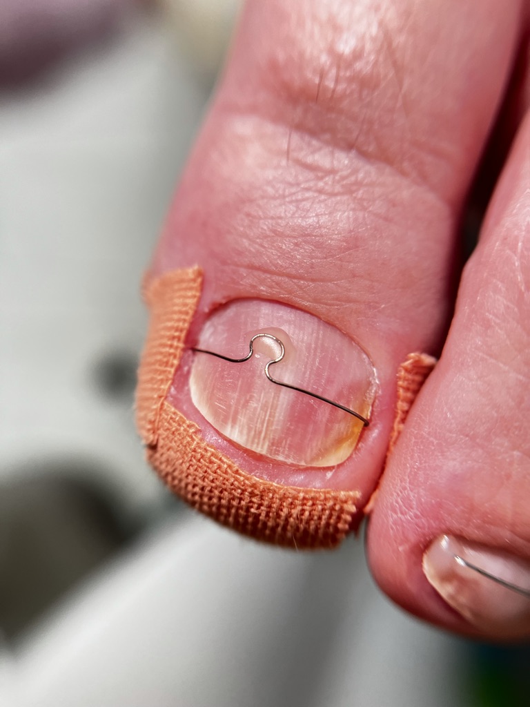 terapia paznokcia klamrA koniec terapii